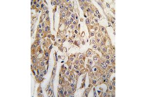 Formalin-fixed and paraffin-embedded human breast carcinoma tissue reacted with PKM2 antibody (C-term ) (ABIN391256 and ABIN2841316) , which was peroxidase-conjugated to the secondary antibody, followed by DAB staining. (PKM2 antibody  (C-Term))