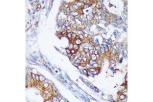 Immunohistochemistry of paraffin-embedded Human colon carcinoma using R Rabbit pAb (ABIN7269785) at dilution of 1:100 (40x lens). (RABGAP1 antibody  (AA 830-1069))