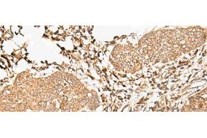 Immunohistochemistry of paraffin-embedded Human esophagus cancer tissue using FER Polyclonal Antibody at dilution of 1:90(x200) (FER antibody)