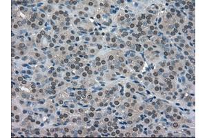 Immunohistochemical staining of paraffin-embedded Adenocarcinoma of ovary tissue using anti-SOD1mouse monoclonal antibody. (SOD1 antibody)
