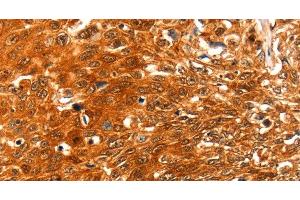 Immunohistochemistry of paraffin-embedded Human esophagus cancer using SERPINB5 Polyclonal Antibody at dilution of 1:60 (SERPINB5 antibody)