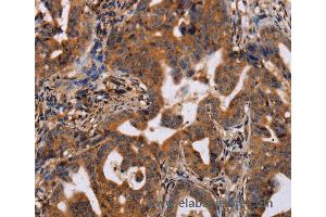 Immunohistochemistry of Human prostate cancer using IL12RB2 Polyclonal Antibody at dilution of 1:40 (IL12RB2 antibody)