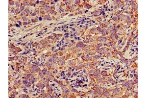 IHC image of ABIN7150697 diluted at 1:300 and staining in paraffin-embedded human pancreatic cancer performed on a Leica BondTM system. (MEK1 antibody  (AA 2-79))