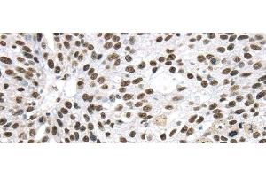 Immunohistochemistry of paraffin-embedded Human breast cancer using DDX39B Polyclonal Antibody at dilution of 1/40 (DDX39B antibody)