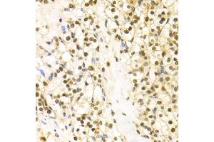 Immunohistochemistry of paraffin-embedded human kidney cancer using BAG1 Antibody (ABIN5970457) at dilution of 1/100 (40x lens). (BAG1 antibody)