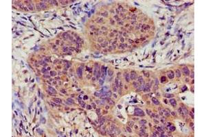 Immunohistochemistry of paraffin-embedded human colon cancer using ABIN7169527 at dilution of 1:100 (TRPC1 antibody  (AA 39-207))