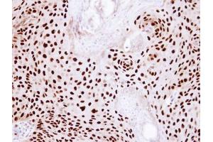 IHC-P Image Immunohistochemical analysis of paraffin-embedded Cal27 Xenograft, using Ku80 (XRCC5), antibody at 1:100 dilution. (X-Ray Repair Cross Complementing 5 antibody)