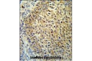 T Antibody (Center) (ABIN651323 and ABIN2840187) IHC analysis in formalin fixed and paraffin embedded bladder carcinoma followed by peroxidase conjugation of the secondary antibody and DAB staining. (TMEM222 antibody  (AA 107-135))