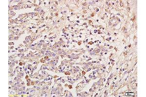 Formalin-fixed and paraffin embedded human pulmonitis labeled with Anti-IL-18R Beta/IL1R7/CD218b Polyclonal Antibody, Unconjugated (ABIN748058) at 1:200 followed by conjugation to the secondary antibody and DAB staining (IL18RAP antibody  (AA 15-120))