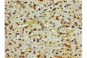 Immunohistochemistry of paraffin-embedded human glioma using ABIN7156245 at dilution of 1:100 (ING1 antibody  (AA 260-353))