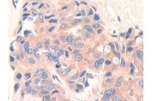 Detection of DEP1 in Human Breast cancer Tissue using Polyclonal Antibody to Density Enhanced Phosphatase 1 (DEP1) (PTPRJ antibody  (AA 1061-1293))