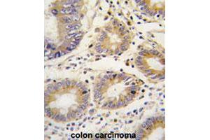 Formalin-fixed and paraffin-embedded human colon carcinomareacted with LEFTY1 polyclonal antibody , which was peroxidase-conjugated to the secondary antibody, followed by AEC staining. (LEFTY1 antibody  (AA 291-320))