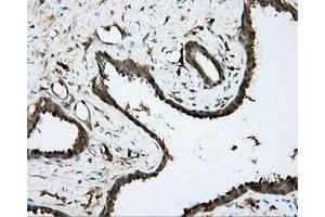 Immunohistochemical staining of paraffin-embedded Carcinoma of prostate tissue using anti-BTK mouse monoclonal antibody. (BTK antibody)