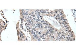Immunohistochemistry of paraffin-embedded Human colorectal cancer tissue using UFM1 Polyclonal Antibody at dilution of 1:45(x200)