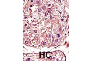 Formalin-fixed and paraffin-embedded human hepatocellular carcinoma tissue reacted with TGFBR1 polyclonal antibody  , which was peroxidase-conjugated to the secondary antibody, followed by AEC staining. (TGFBR1 antibody  (Internal Region))