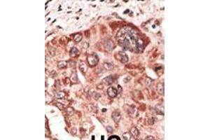 Formalin-fixed and paraffin-embedded human cancer tissue reacted with the primary antibody, which was peroxidase-conjugated to the secondary antibody, followed by DAB staining. (Recoverin antibody  (C-Term))