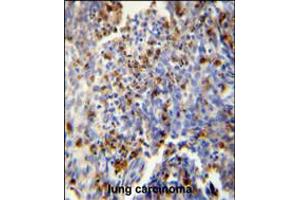 FOSL2 antibody immunohistochemistry analysis in formalin fixed and paraffin embedded human lung carcinoma followed by peroxidase conjugation of the secondary antibody and DAB staining. (FOSL2 antibody  (AA 95-122))