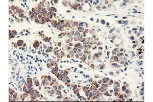 Immunohistochemical staining of paraffin-embedded Carcinoma of Human lung tissue using anti-EIF2B3 mouse monoclonal antibody. (EIF2B3 antibody)