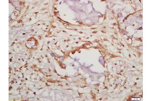Formalin-fixed and paraffin embedded human lung carcinoma labeled with Anti-Caspase 14 Polyclonal Antibody, Unconjugated (ABIN1714934) at 1:200 followed by conjugation to the secondary antibody and DAB staining (CASP14 antibody  (AA 155-242))