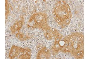 IHC-P Image Immunohistochemical analysis of paraffin-embedded Ca922 xenograft, using INPP5B, antibody at 1:100 dilution. (INPP5B antibody  (C-Term))