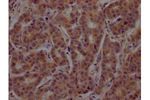 IHC image of ABIN7148794 diluted at 1:200 and staining in paraffin-embedded human breast cancer performed on a Leica BondTM system. (ATF4 antibody  (AA 20-200))