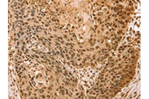 The image on the left is immunohistochemistry of paraffin-embedded Human esophagus cancer tissue using ABIN7131133(SNX8 Antibody) at dilution 1/25, on the right is treated with fusion protein.
