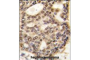 Formalin-fixed and paraffin-embedded human hepatocarcinoma tissue reacted with HDGF antibody , which was peroxidase-conjugated to the secondary antibody, followed by DAB staining. (HDGF antibody  (C-Term))
