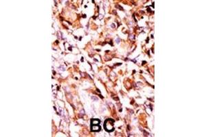 Formalin-fixed and paraffin-embedded human cancer tissue reacted with the primary antibody, which was peroxidase-conjugated to the secondary antibody, followed by AEC staining. (BAD antibody  (pSer99))