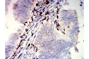 Immunohistochemical analysis of paraffin-embedded rectum cancer tissues using CD274 mouse mAb with DAB staining. (PD-L1 antibody  (AA 24-153))