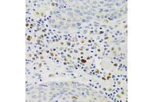 Immunohistochemistry of paraffin-embedded human lung cancer using GEMIN2 Antibody. (SIP1 antibody)