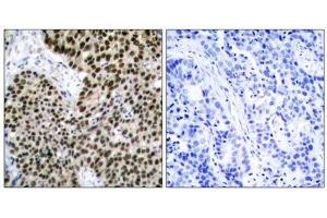 Immunohistochemical analysis of paraffin-embedded human breast carcinoma tissue using HSF1 (Ab-303) antibody (E021255). (HSF1 antibody)