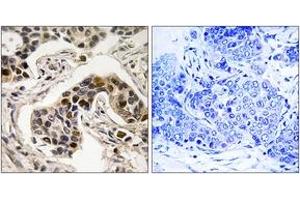 Immunohistochemistry analysis of paraffin-embedded human breast carcinoma, using NudC (Phospho-Ser326) Antibody. (NUDC antibody  (pSer326))