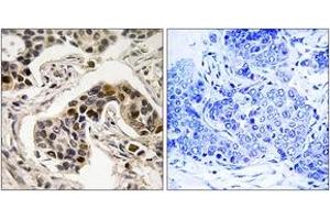 Immunohistochemistry analysis of paraffin-embedded human breast carcinoma, using NudC (Phospho-Ser326) Antibody.
