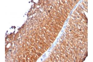 Formalin-fixed, paraffin-embedded human Bladder Carcinoma stained with Mitochondria Monoclonal Antibody (MTC719) (Mitochondrial Marker antibody)