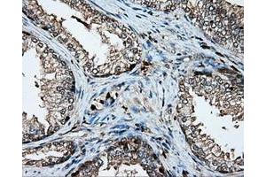 Immunohistochemical staining of paraffin-embedded Adenocarcinoma of colon tissue using anti-PLEK mouse monoclonal antibody.