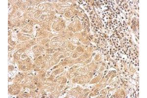 IHC-P Image NAGLU antibody detects NAGLU protein at cytosol on human hepatoma by immunohistochemical analysis. (NAGLU antibody  (Center))