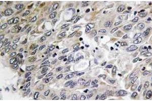 Immunohistochemistry (IHC) analyzes of C1q-C antibody in paraffin-embedded human lung carcinoma tissue. (C1QC antibody)