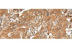Immunohistochemistry of paraffin-embedded Human cervical cancer tissue using GFI1 Polyclonal Antibody at dilution of 1:100(x200) (GFI1 antibody)