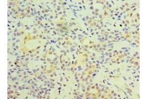 Immunohistochemistry of paraffin-embedded human breast cancer using ABIN7153128 at dilution of 1:100 (FOSL2 antibody  (AA 187-326))