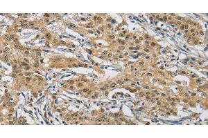 Immunohistochemistry of paraffin-embedded Human gastric cancer using NAPSA Polyclonal Antibody at dilution of 1:50 (NAPSA antibody)