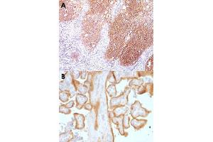 Immunohistochemical staining (Formalin-fixed paraffin-embedded sections) of human lung squamous cell carcinoma (A, B) with EGFR monoclonal antibody, clone GFR/1667 .