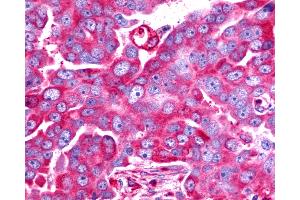 Anti-TAAR6 antibody IHC of human Ovary, Carcinoma. (TAAR6 antibody  (C-Term))