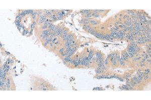 Immunohistochemistry of paraffin-embedded Human colon cancer using EPS15L1 Polyclonal Antibody at dilution of 1:30 (EPS15L1 antibody)