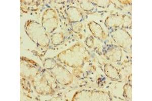 Immunohistochemistry of paraffin-embedded human gastric cancer using ABIN7176189 at dilution of 1:100 (ZNF26 antibody  (AA 335-533))