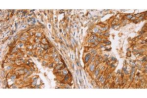 Immunohistochemistry of paraffin-embedded Human cervical cancer using CD59 Polyclonal Antibody at dilution of 1:50 (CD59 antibody)