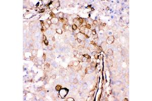 Anti- Gelsolin antibody, IHC(P) IHC(P): Human Mammary Cancer Tissue (Gelsolin antibody  (AA 580-782))