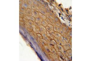 CB2 antibody (C-term) (ABIN654631 and ABIN2844327) immunohistochemistry analysis in formalin fixed and paraffin embedded human skin carcinoma followed by peroxidase conjugation of the secondary antibody and DAB staining.