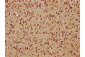 IHC image of ABIN7152257 diluted at 1:560 and staining in paraffin-embedded human glioma cancer performed on a Leica BondTM system. (EXOC7 antibody  (AA 521-735))