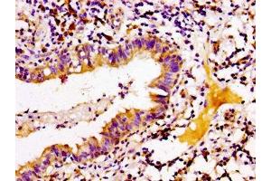 IHC image of ABIN7144779 diluted at 1:100 and staining in paraffin-embedded human lung cancer performed on a Leica BondTM system. (ARID3A antibody  (AA 26-137))