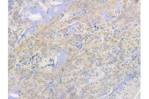 ABIN6264471 and ABIN6278269 at 1/100 staining human lung adenocarcinoma by IHC-P.
